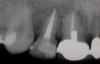 Root Canal Irrigation In Modern Endodontics - Part 1