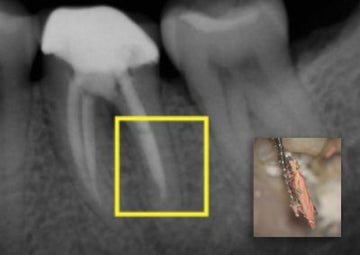 Obturation: Sealing the Root Canal System