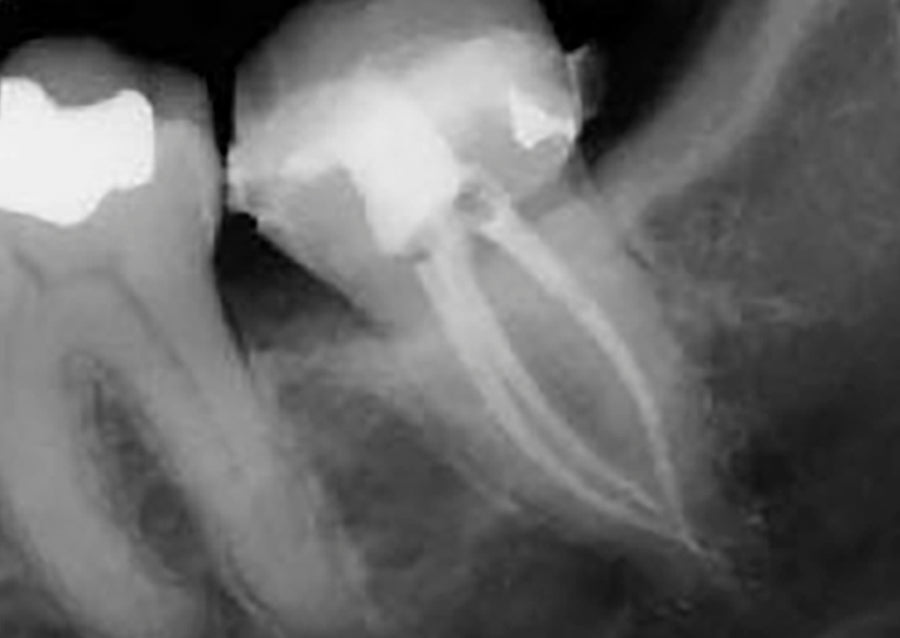 Endodontic Management of the Mandibular Second Molar