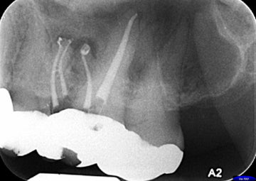 Endodontic Treatment Planning in the 4th Dimension